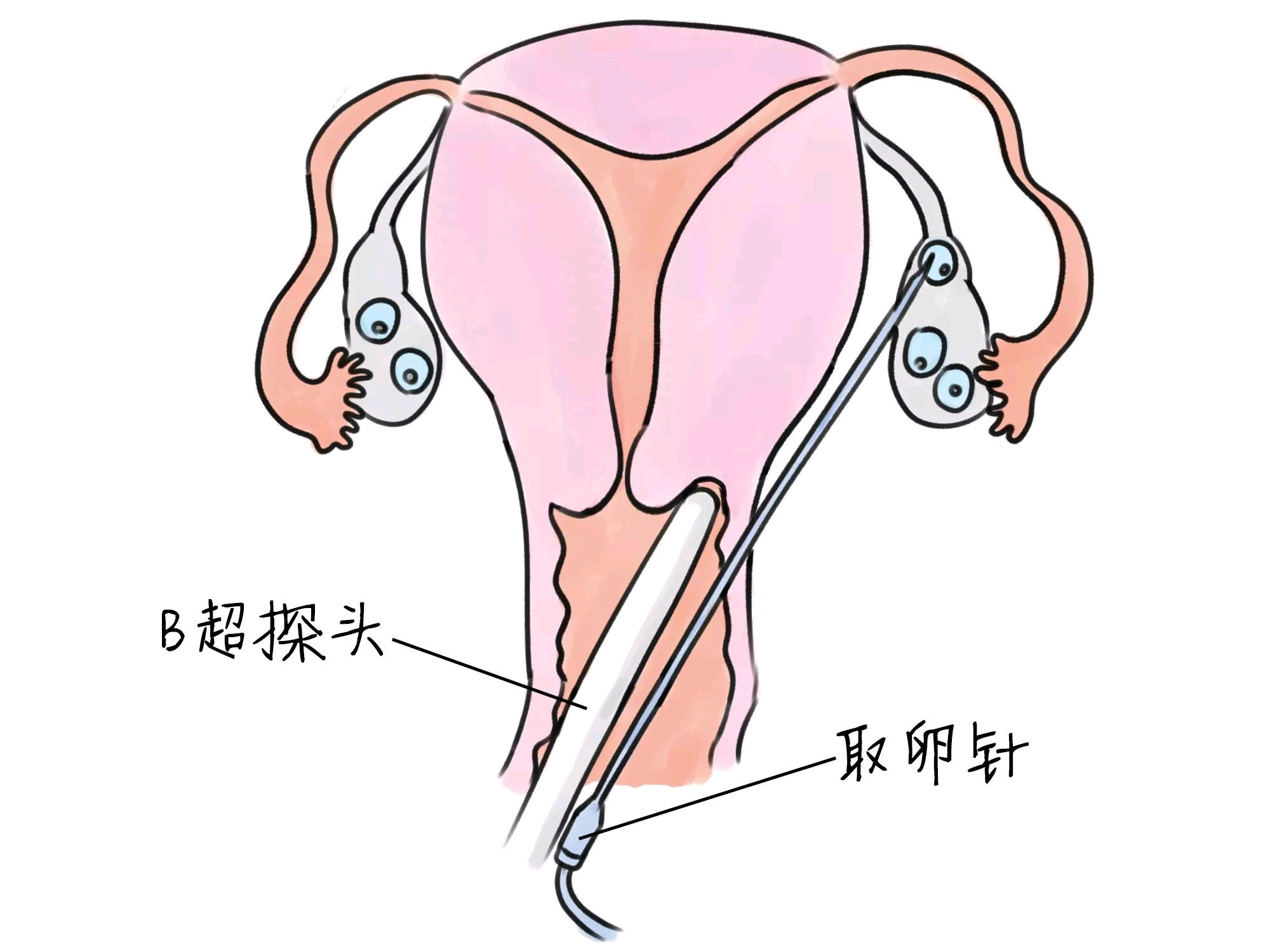 不孕不育代孕