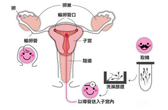 捐卵代孕